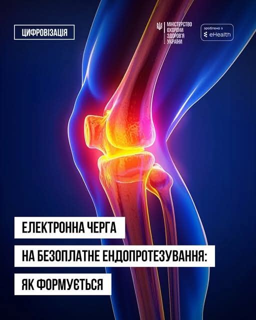 Послуга з ендопротезування є безоплатною для пацієнта