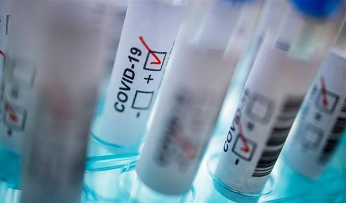 Лабораторно підтверджено 77 нових випадків COVID-19 в області