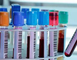 Лабораторно підтверджено 117 нових випадків COVID-19 в області. Внаслідок ускладнень померло ще п’ять осіб