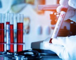 Лабораторно підтверджено 124 нових випадки COVID-19 в області. Померли дев’ять осіб. В Україні черговий антирекорд – 16 294 інфікованих за добу